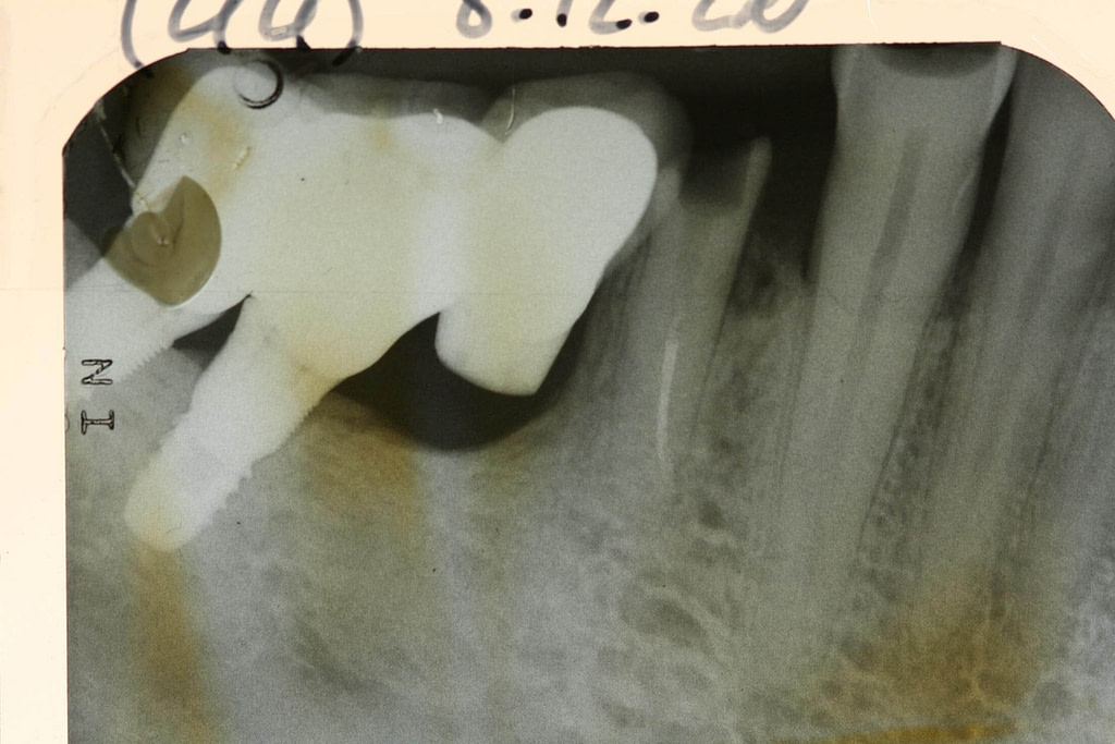 Implant court et hygiène bucco-dentaire maitrisée
