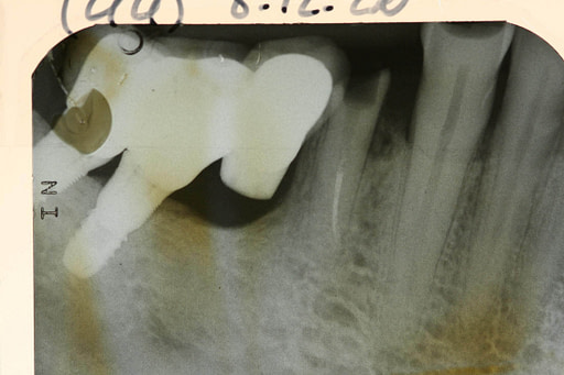 Implant court et hygiène bucco-dentaire maitrisée