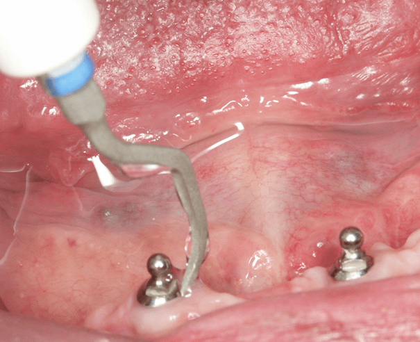 Intérêt des inserts carbone pour la maintenance implantaire (ici un insert PH1 Satelec)