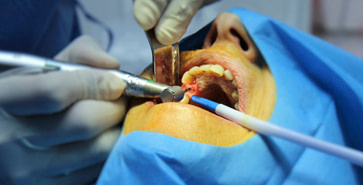 Quel est le protocole de forage à adopter en implantologie dentaire ?