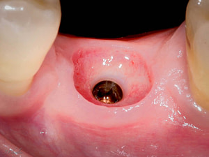 Emergence prothétique en implantologie dentaire