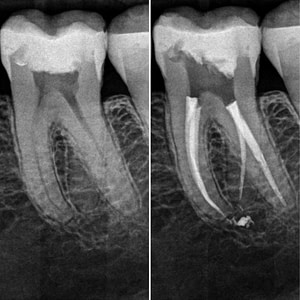 Traitement endodontique par le Dr. Hugo SETBON