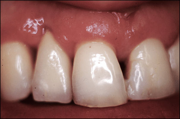 Aspect clinique en 1997. Hygiène correcte mais patiente fumeuse et nettoyage inter dentaire insuffisant